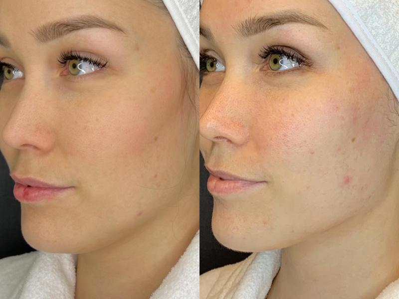 Биоревитализация кожи лица